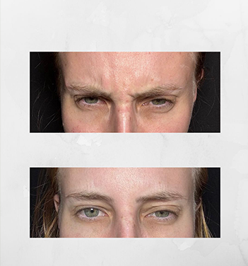Resultado harmonização facial
