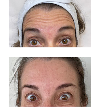 Resultado harmonização facial