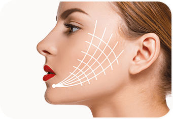 Fios de PDO para contorno facial